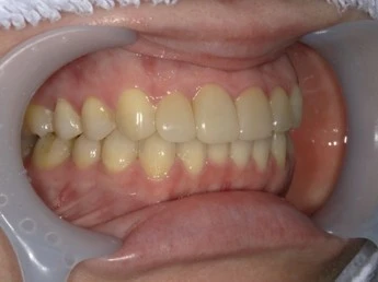 Case01　審美治療後