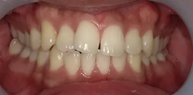 Case02　治療前