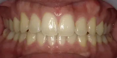 Case02　治療後