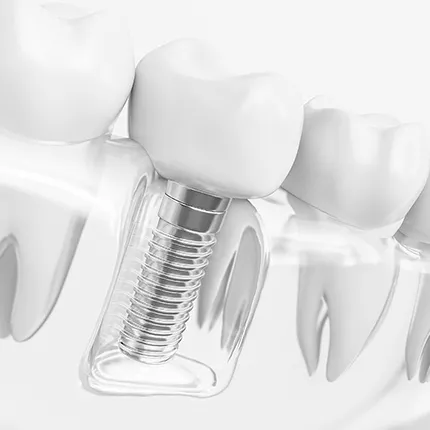 インプラントやブリッジがあっても対応可能！