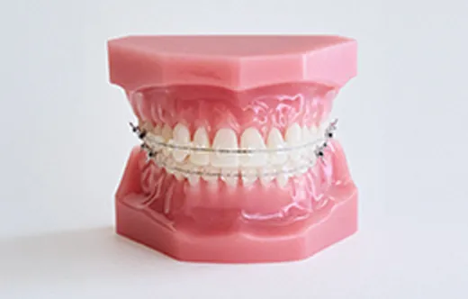 唇側（表側）矯正装置