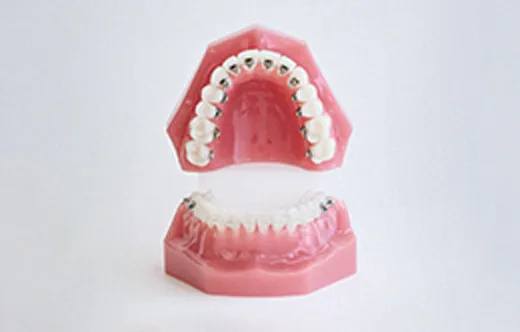 舌側（裏側）矯正装置