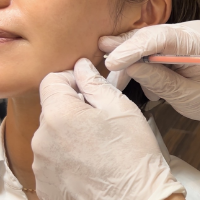 咬筋ボトックス