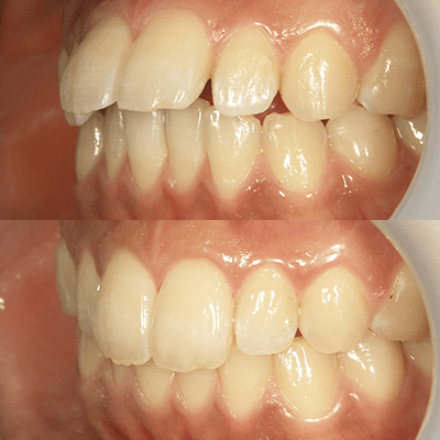 インビザライン矯正（上）1