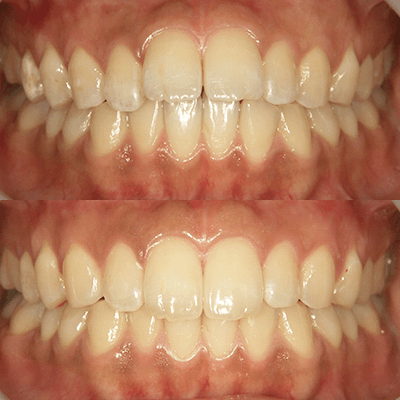 インビザライン矯正（上）2