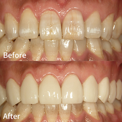 ラミネートベニア