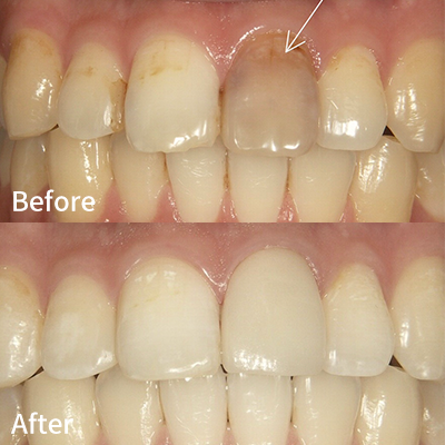 セラミッククラウン法+ダイレクトボンディング+ホワイトニング