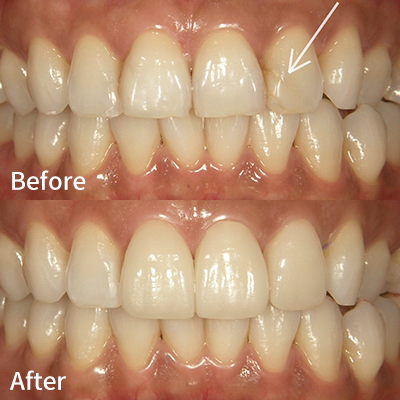 ラミネートベニア法