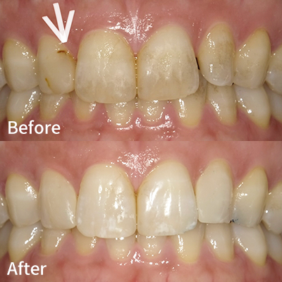 ダイレクトボンディング法