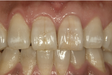 前歯のヒビは自然治癒する？