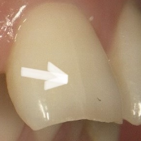 マイクロクラック