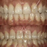象牙質まで達したヒビ