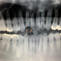 神経に近い部分まで進んだヒビ