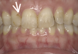 ダイレクトボンディング