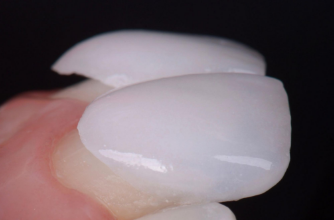 ラミネートベニア