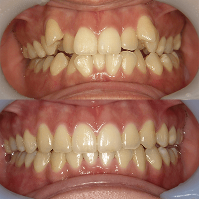 「ガタガタの歯並び」の治療例