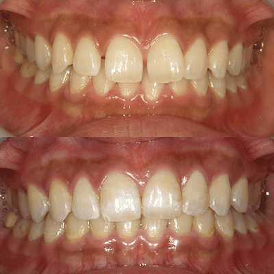 「すきっ歯」の治療例
