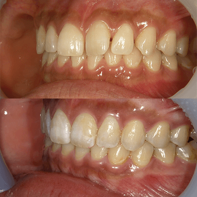 「すきっ歯」の治療例2
