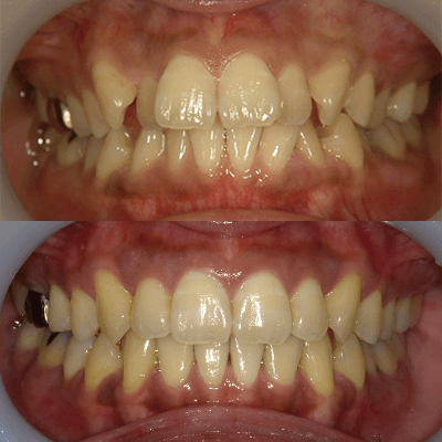 「前歯が引っ込んでいる、出っ歯」の治療例
