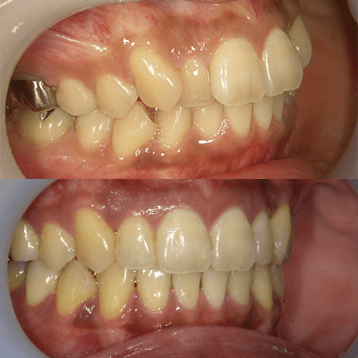 「前歯が引っ込んでいる、出っ歯」の治療例2