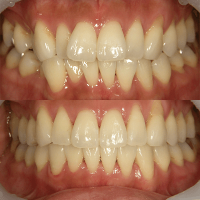 「噛み合わせが悪い」歯並びの治療例