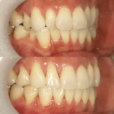 「噛み合わせが悪い」歯並びの治療例2