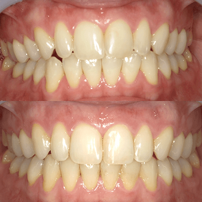 「歯のねじれ」の治療例