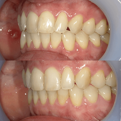 「歯のねじれ」の治療例2