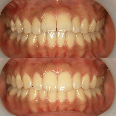 「出っ歯」の治療例