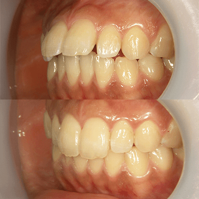 「出っ歯」の治療例2