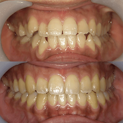 「歯の真ん中がずれている」の治療例