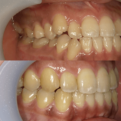 「歯の真ん中がずれている」の治療例2