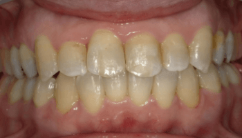 front/矯正治療After