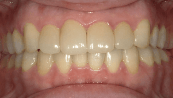 front/審美治療後