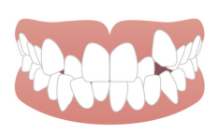 前歯がガタガタしている（叢生）