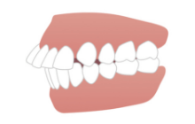 前歯が前に出ている（出っ歯）