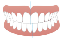 噛み合わせが深い（過蓋咬合）