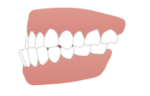 歯の真ん中と顔の真ん中が合っていない（正中の不一致）
