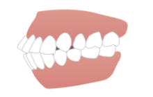 口ゴボ（上下顎前突）