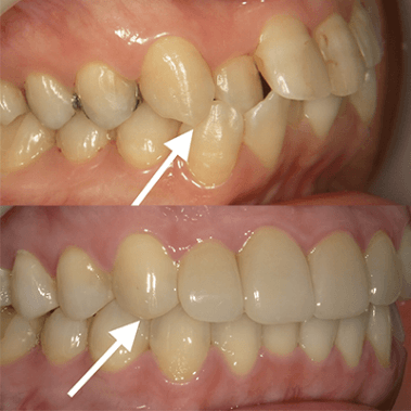 矯正治療後の歯のかたちの修正や審美治療も可能