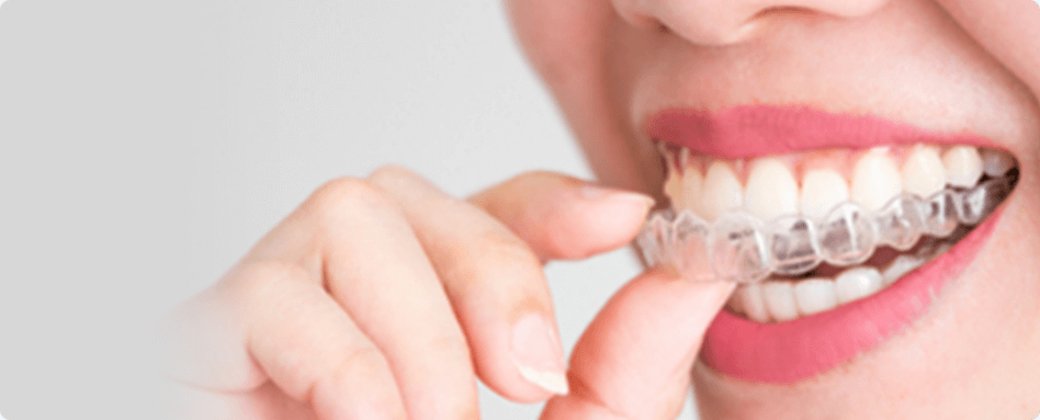 マウスピース矯正