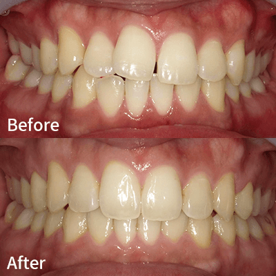 歯の真ん中が合っていない、歯が曲がっている（正中の不一致）の症例2