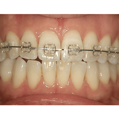 表側ワイヤー（前歯部分矯正）の症例1