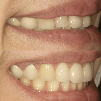 前歯セラミッククラウン治療1-1