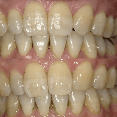 歯の形態修正とダイレクトボンディングのコンビネーション