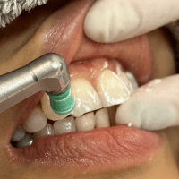 ホワイトニング剤の除去/歯の保護.ポリッシュでの仕上げ