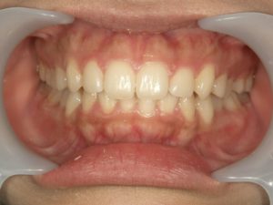 前歯のすき間の治療法　すきっ歯を治す方法とは？