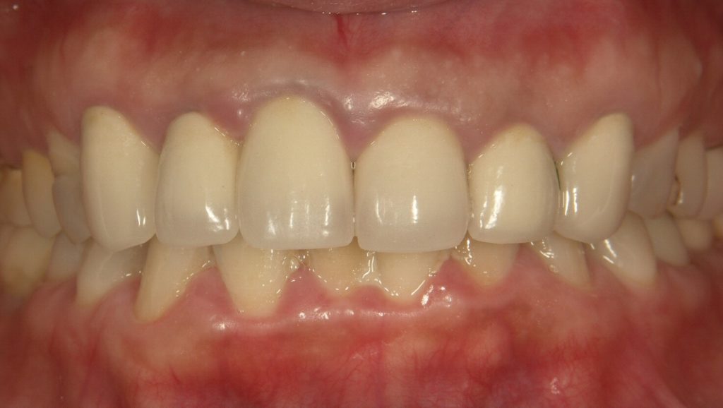 白さ かたち 歯肉までも美しくする前歯の審美治療