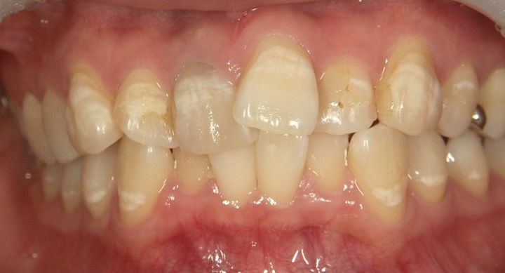 見て頂きたいのは 矯正治療の治療前後 ではなく 歯の白い縞模様部分