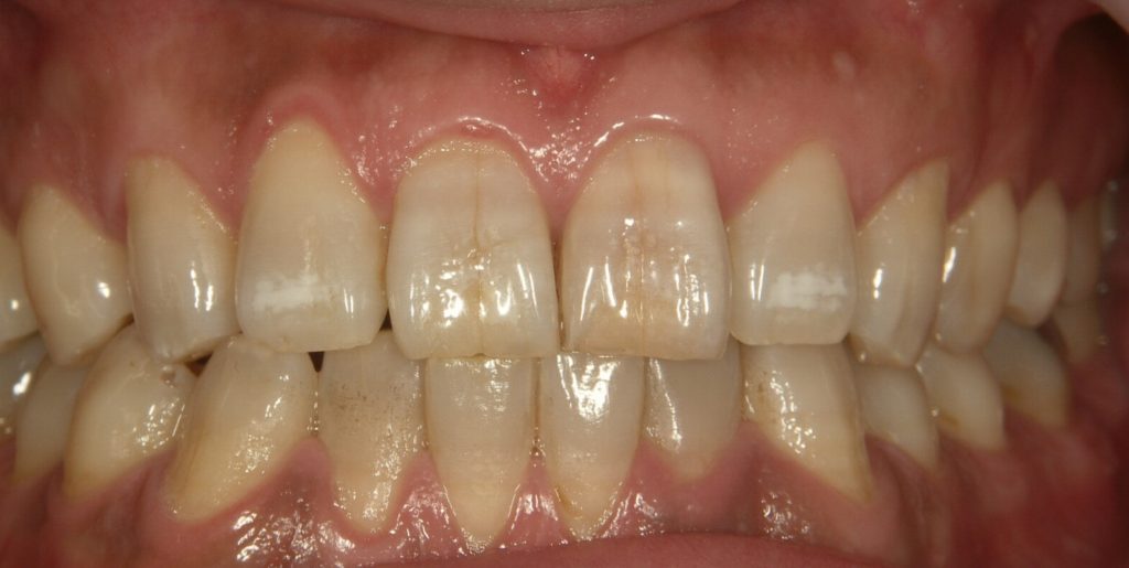 歯のホワイトニング 歯を白くする方法色々